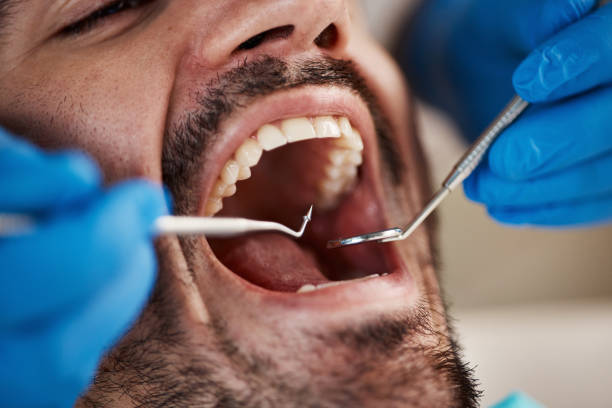 Best Knocked-Out Tooth Emergency  in Saratoga, WY